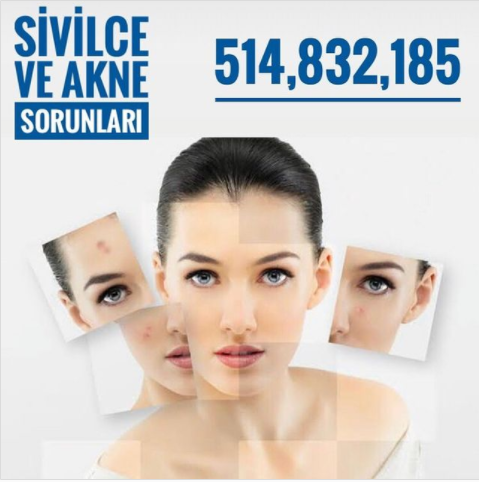 Sivilce ve Akne Sorunları
