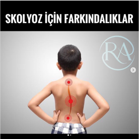Skolyoz